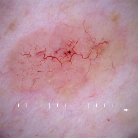 Resection of the liver for colorectal carcinoma. Il Basalioma o Carcinoma basocellulare: il Tumore cutaneo ...