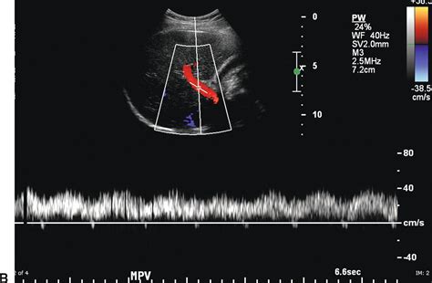 Right And Left Portal Vein Ultrasound