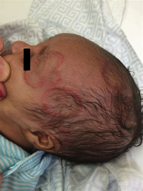 3 Week Old Presents With Rapidly Spreading Erythematous Annular Lesions