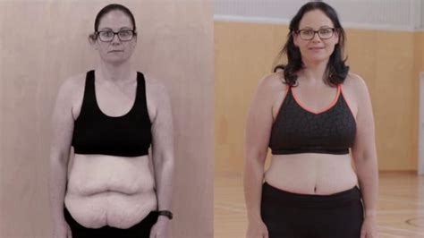 Gastric Bypass Before And After Pictures How Life Will Change