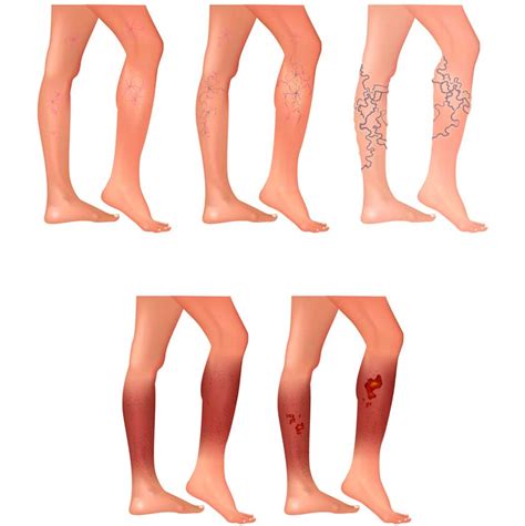 Five best essential oils for varicose veins. VARICOSE VEINS Removal of Varicose Veins and Spider Veins ...