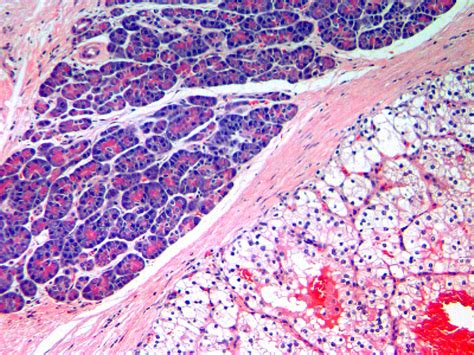 Cureus Renal Cell Carcinoma Metastases To The Pancreas And The