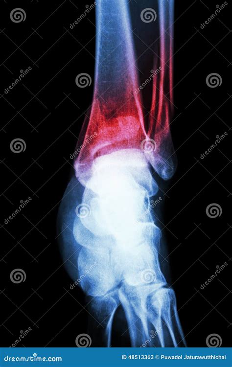 Distal Tibia Fracture And Distal Fibular Fusion Royalty Free Stock