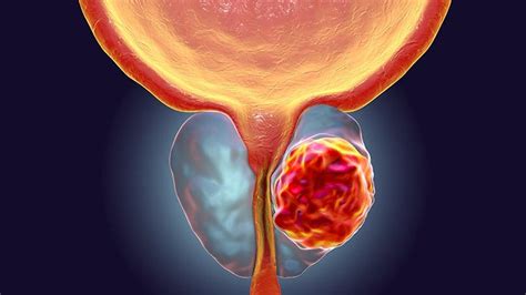 How is prostate cancer treated? ¿Qué es el cáncer de próstata? | Síntomas, causas y cómo ...