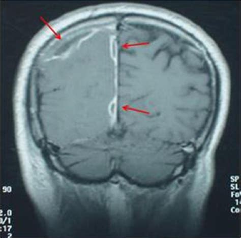 Figure 9 From Ct And Mri Imaging Of Chronic Otitis Media Complications