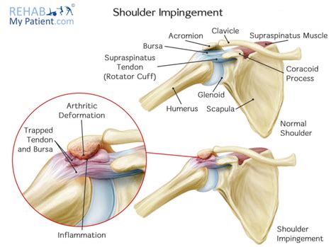Shoulder Impingement Motus Physical Therapy