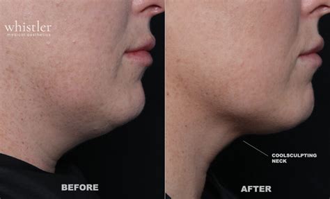 Coolsculpting Under Chin Amazing Results