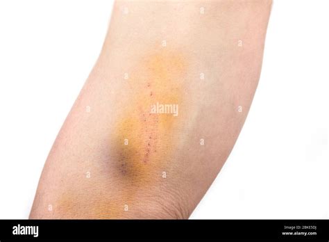 Hematoma Arm Hi Res Stock Photography And Images Alamy
