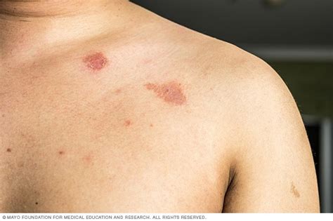 Ringworm On A Shoulder Mayo Clinic