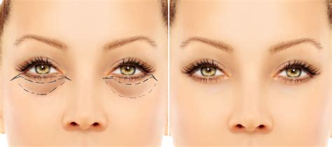 What Is Skin Pinch Lower Eyelid Surgery