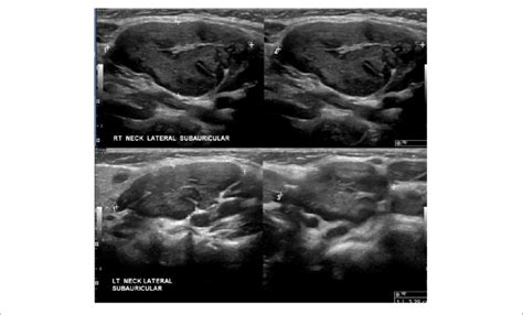 Ultrasound Benign Lymph Nodes Neck