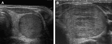 Ultrasound Of Thyroid Nodules Radiology Key