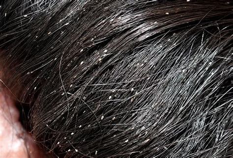 48 Best Pictures What Does Lice Look Like In Black Hair What Does It