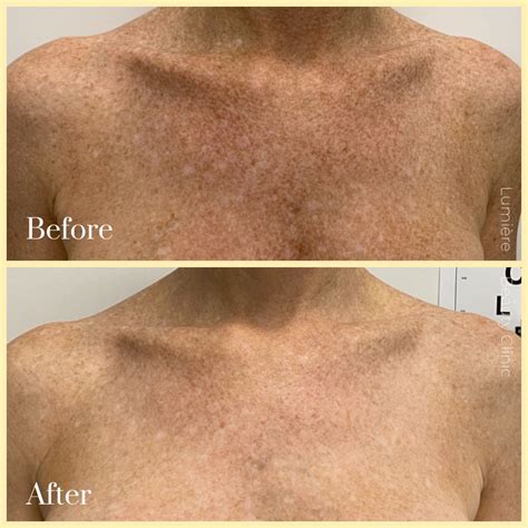 Laser Pigmentation Removal And Treatment Sydney Prices From 399 To 800
