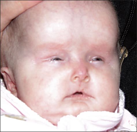 Instead, treatment aims to manage symptoms and prevent or treat complications. Macular Retinal Detachment in Hallermann-Streiff Syndrome ...