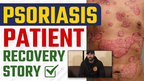 Psoriasis Patient Recovery सोरायसिस कैसे हुआ ठीक Dr Health Dr
