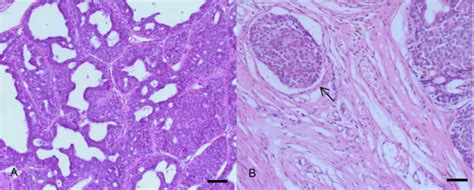 Scielo Brasil Tubulopapillary Carcinoma Of The Mammary Gland In A