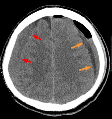 Bilateral Subacute Subdural Hematomas