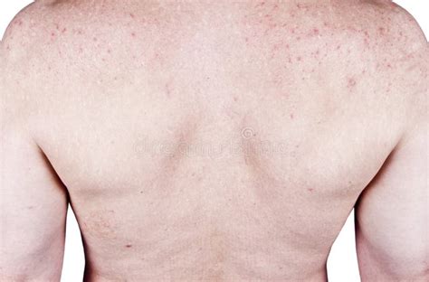 Adult Male Acne Skins Problems Blemishes Rash Stock Photo Image Of