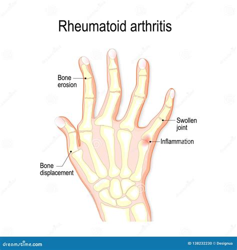 X Ray Hand Arthritis Stock Illustration 12716473