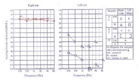 Pure Tone Audiometry Showing Profound Hearing Loss In The Left Ear And
