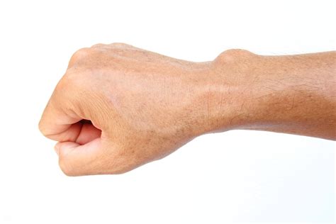 Ganglion Cysts Of The Hand And Wrist Arlington Orthopedics Associates P A Arlington Texas