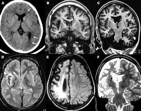 A Ct Left Hemispheric Atrophy With Ventricular And Cortical Sulci