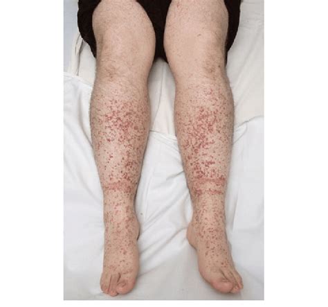 1 Purpuric Lesions On The Legs Of A Patient With Henochschönlein