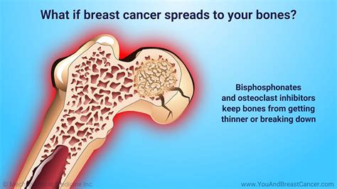 Pin On Metastatic Breast Cancer