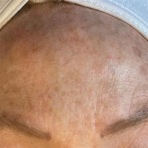 Chemical Peels By Fine Line Aesthetics In Frisco Texas