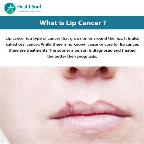 Lip Cancer Causes Symptoms And Treatment Healthsoul