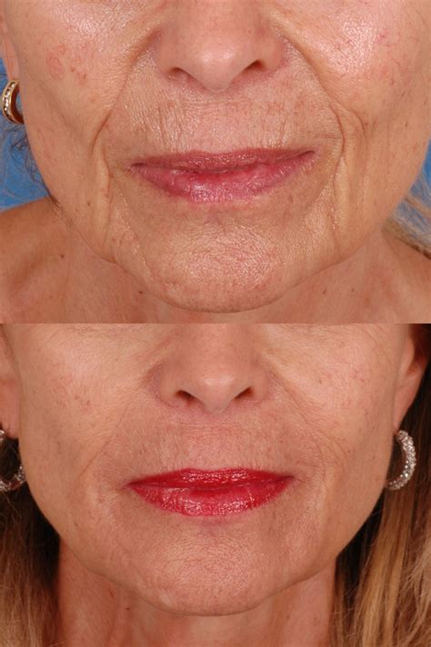 facial fillers before and after photos dr bassichis