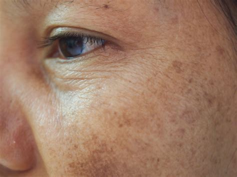 What Causes Skin Pigmentation How To Remove It