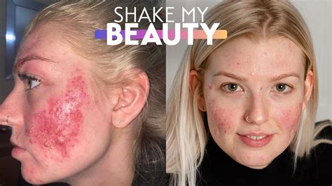 My Cystic Acne Is So Bad It Went Viral Shake My Beauty Youtube