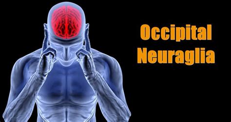 Overview Occipital Neuralgia Also Known As C2 Neuralgia Or Rarely