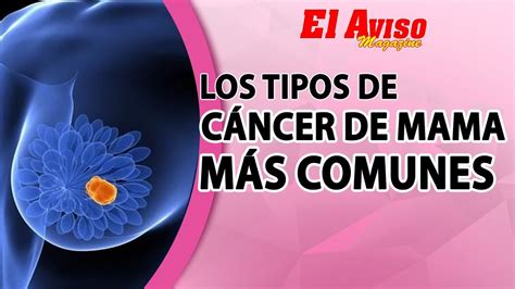 QUÉ ES EL CANCER DE MAMA Y LOS DIFERENTES TIPOS DE CANCER El Aviso Magazine YouTube