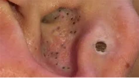Biggest Blackhead Pimple Popping Ever Cyst Explosion