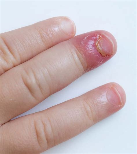 Staph Infection In Toddlers Signs Prevention And Treatments