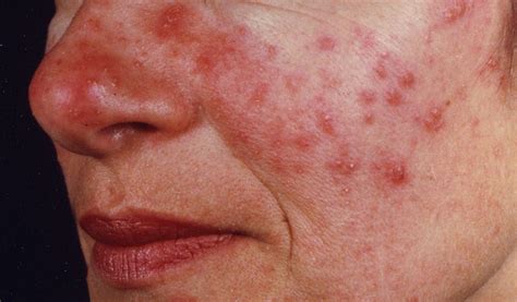 Pin On Rosacea