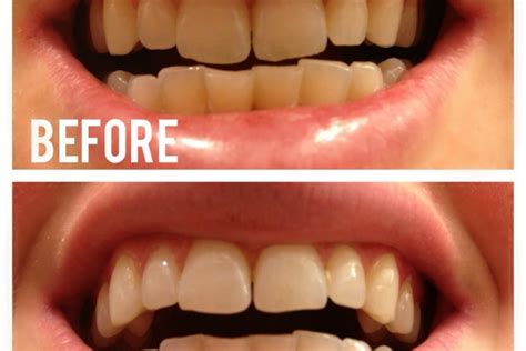 Will Activated Charcoal Whiten Your Teeth Teeth Poster