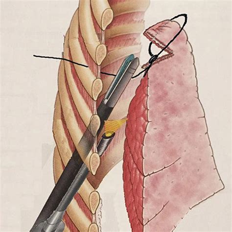 Surgical Field Showing The Camera Inside The Chest Cavity And The Loop
