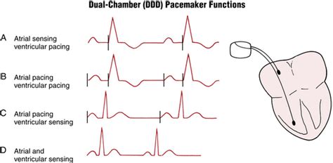 Pacemakers And Implantable Cardioverter Defibrillators Essentials For