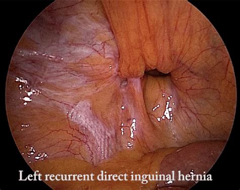 Showing Left Recurrent Direct Inguinal Hernia With Mesh Seen Displaced Download Scientific