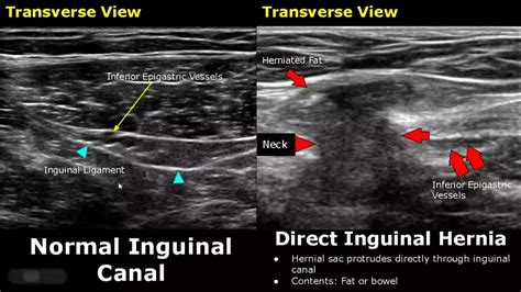 Hernia Ultrasound Normal Vs Abnormal Images Directindirect Inguinal