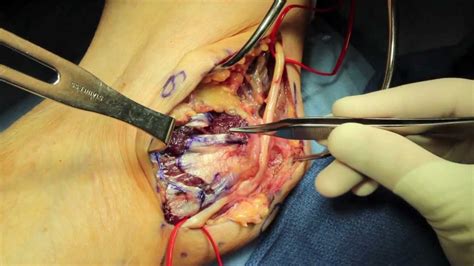 Live Surgery Cubital Tunnel Ulnar Nerve Transposition Decompression