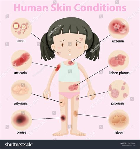 Diagram Showing Human Skin Conditions Illustration Stockvektor
