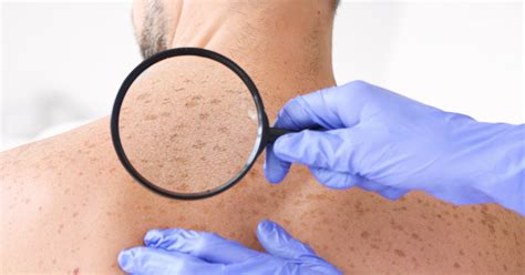 What Causes White Spots On Skin Risks And Treatments Dcsi