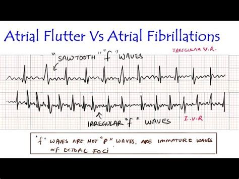 Atrial Flutter Vs Atrial Fibrillation Ecg