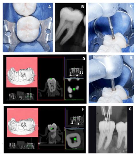 Operative Procedures For Sample Molar Tooth Occlusal Pre Operative