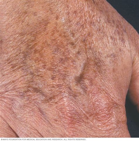 Age Spots Liver Spots Symptoms Mayo Clinic